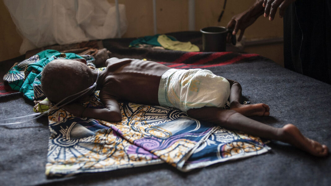 Experts advocate food fortification to stem malnutrition
